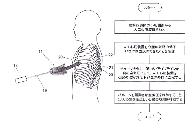 緊急の現場で装着できる人工心筋
