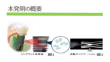 キャビテーションを利用した口腔洗浄装置