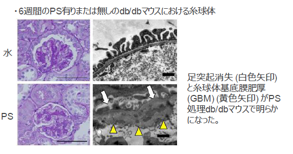 糖尿病性腎症の判定マーカー