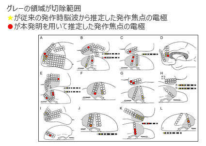 てんかん原性領域の推定プログラム