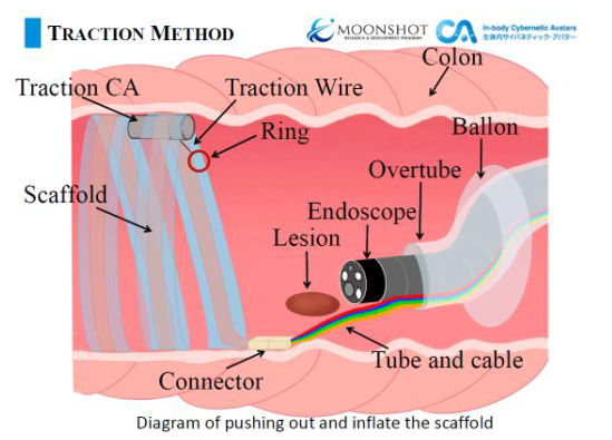内視鏡治療用牽引システム