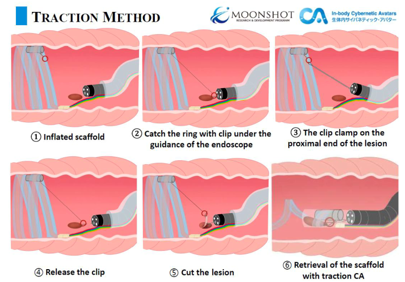 内視鏡治療用牽引システム